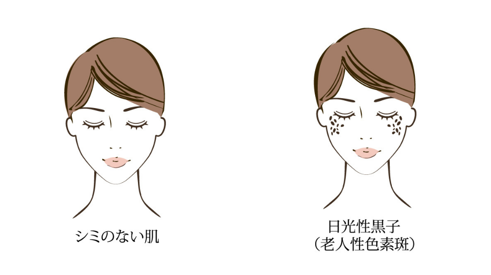 シミの原因と正しい対策法|今日からできる効果的な対策とは?