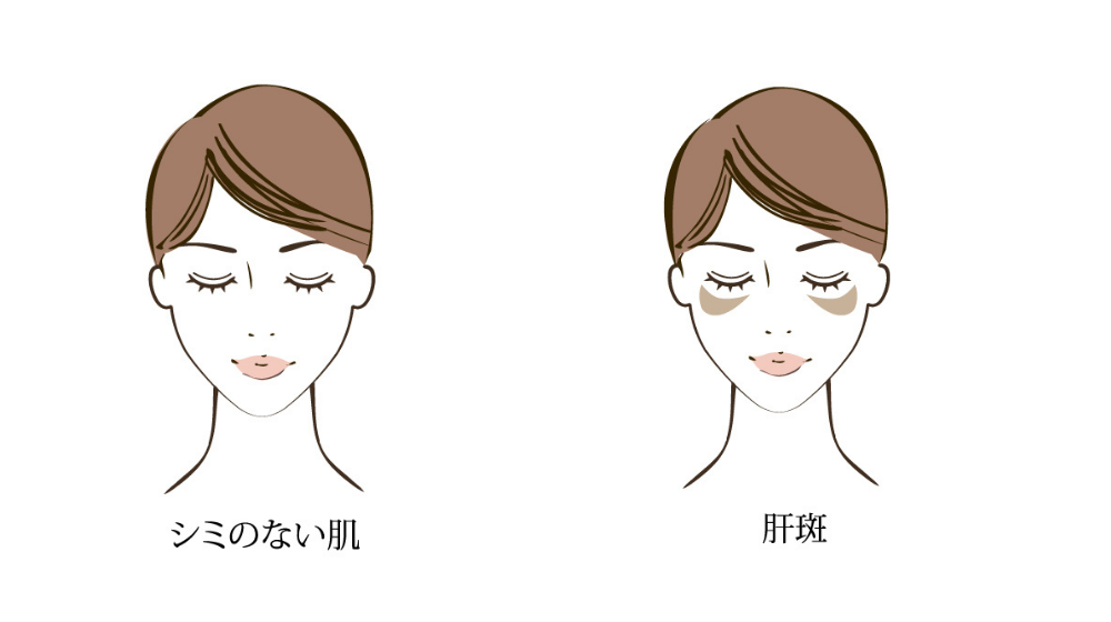 シミの原因と正しい対策法|今日からできる効果的な対策とは?
