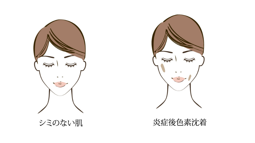 シミの原因と正しい対策法|今日からできる効果的な対策とは?