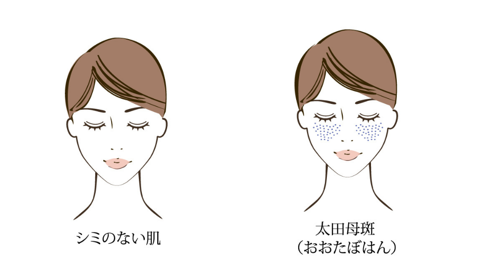 シミの原因と正しい対策法|今日からできる効果的な対策とは?