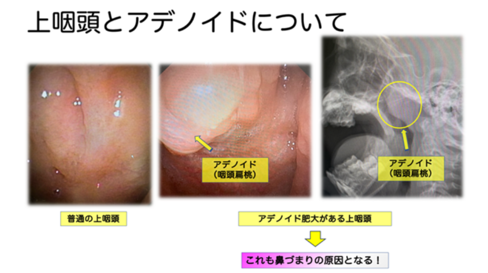 鼻詰まりの原因は?日常でできる解消方法や長引く場合の対処法を紹介