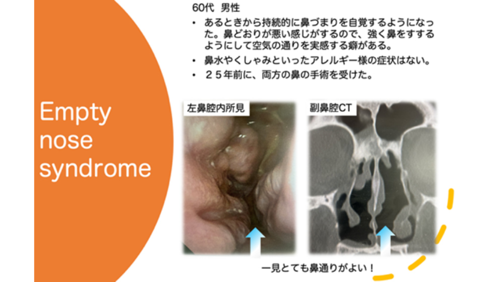 鼻詰まりの原因は?日常でできる解消方法や長引く場合の対処法を紹介