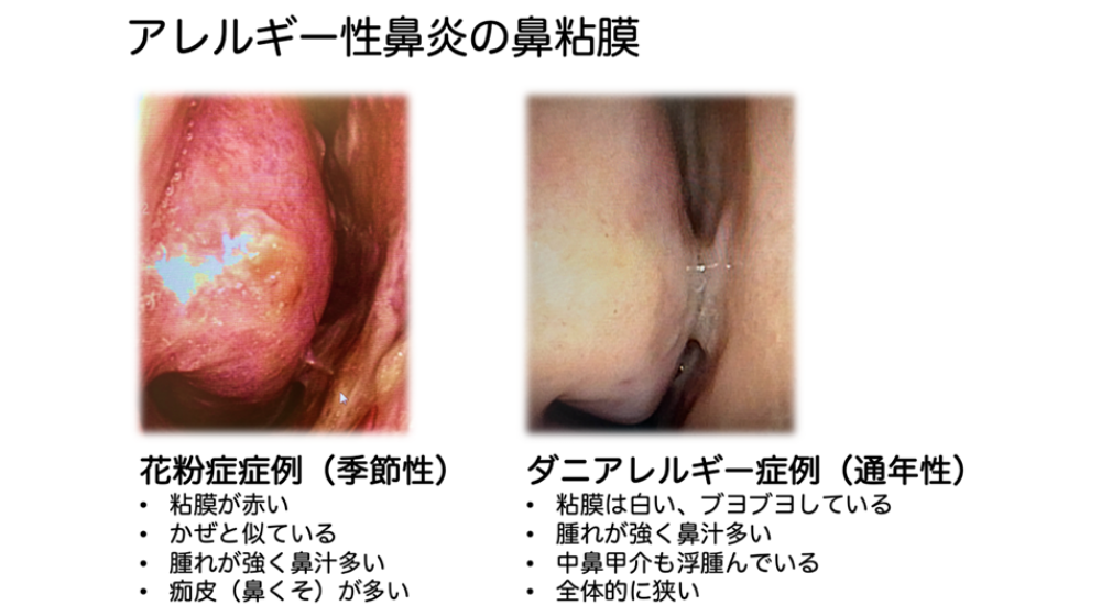 鼻詰まりの原因は?日常でできる解消方法や長引く場合の対処法を紹介