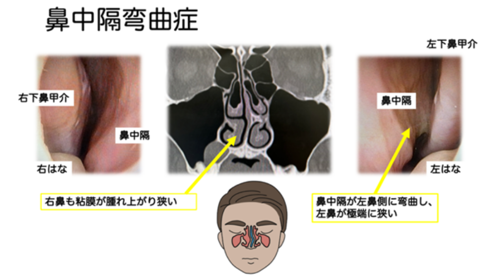 鼻詰まりの原因は?日常でできる解消方法や長引く場合の対処法を紹介
