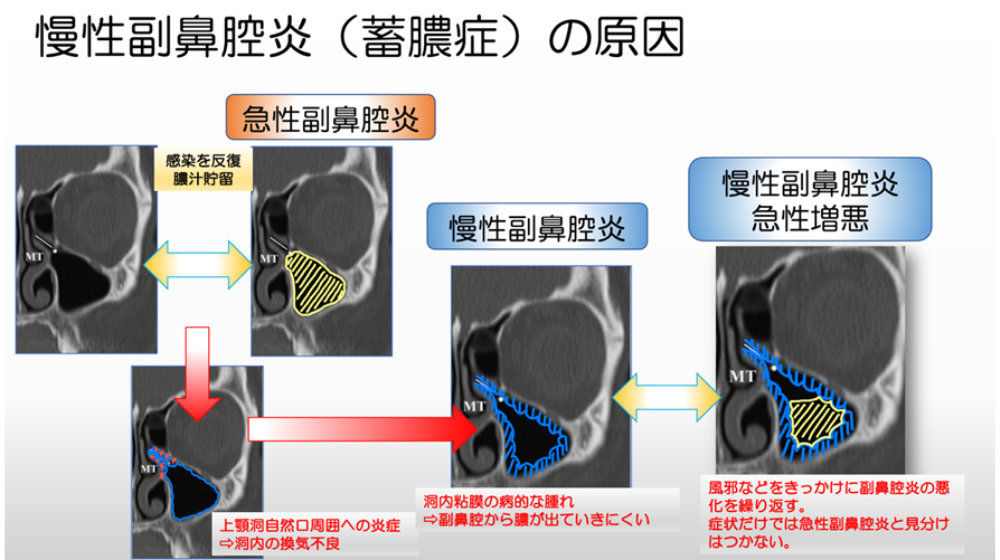 鼻詰まりの原因は?日常でできる解消方法や長引く場合の対処法を紹介