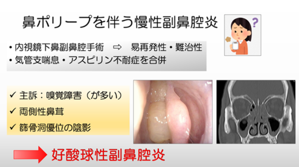 鼻詰まりの原因は?日常でできる解消方法や長引く場合の対処法を紹介