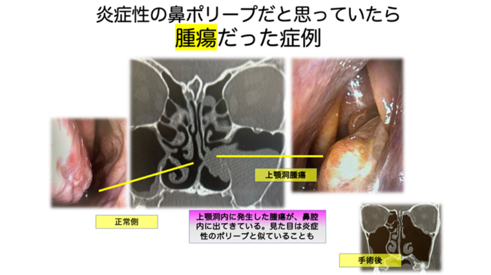 鼻詰まりの原因は?日常でできる解消方法や長引く場合の対処法を紹介