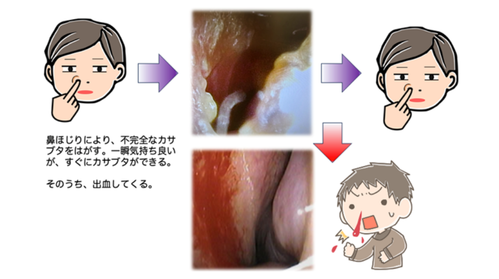 鼻詰まりの原因は?日常でできる解消方法や長引く場合の対処法を紹介