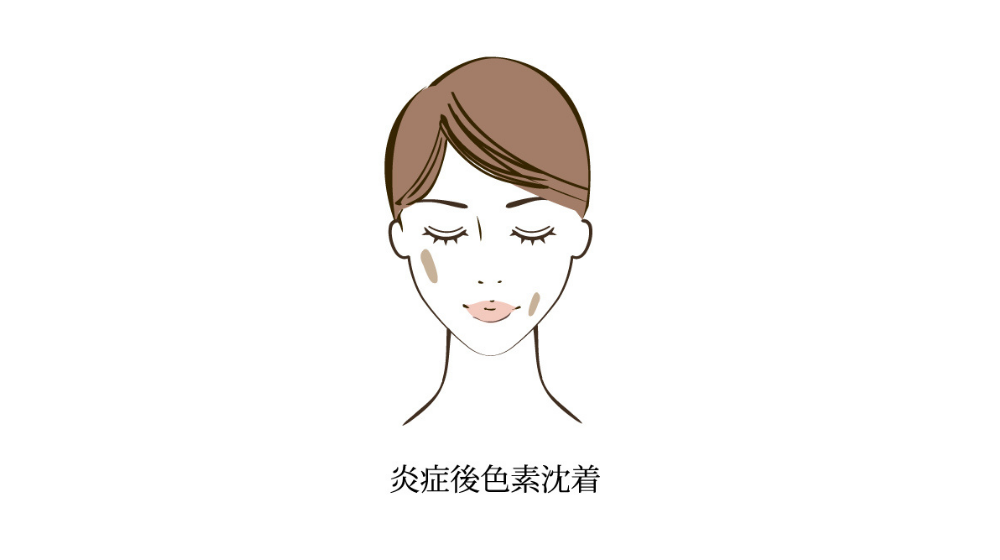 シミができやすい人の特徴とは?肌を守るための予防とスキンケア方法